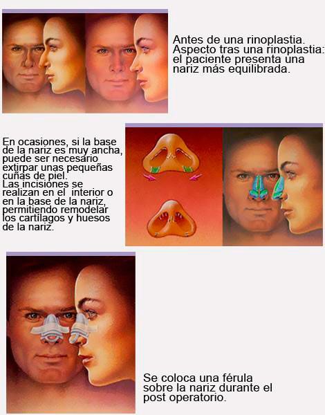 Rinoplastia 