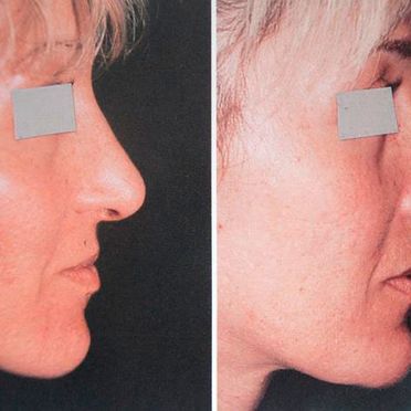 Cirugía de nariz antes y después