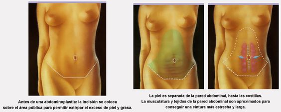 Abdominoplastia 