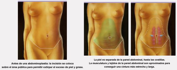 Abdominoplastia 