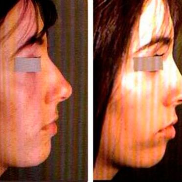 Cirugía de nariz antes y después
