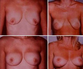 Aumento y reducción de mamas