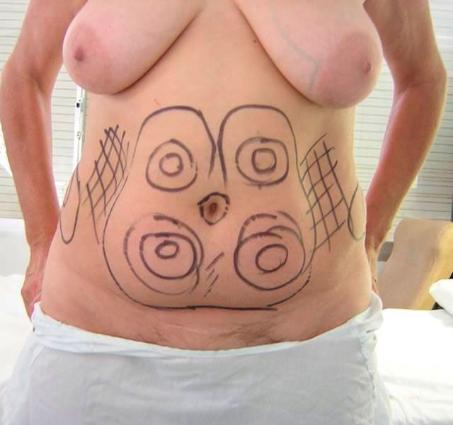 Abdomen pintado 