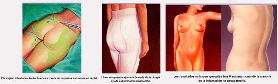 Liposucción 