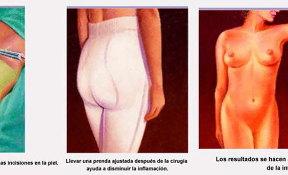 Liposucción 