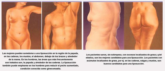 Información de liposucción