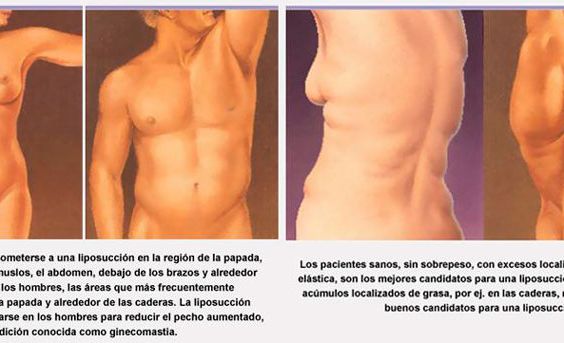 Información de liposucción