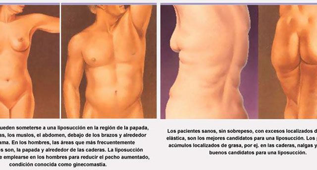 Información de liposucción