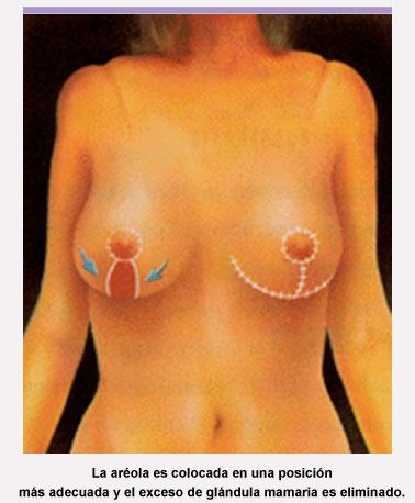 reducción de mamas 1